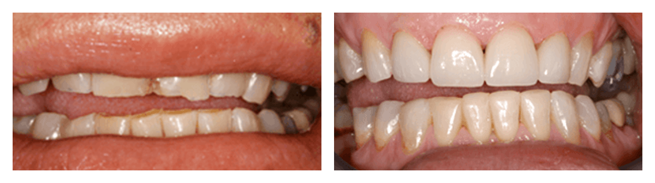 Teeth Whitening, Cosmetic Bonding And E-Max Veneers Before & After