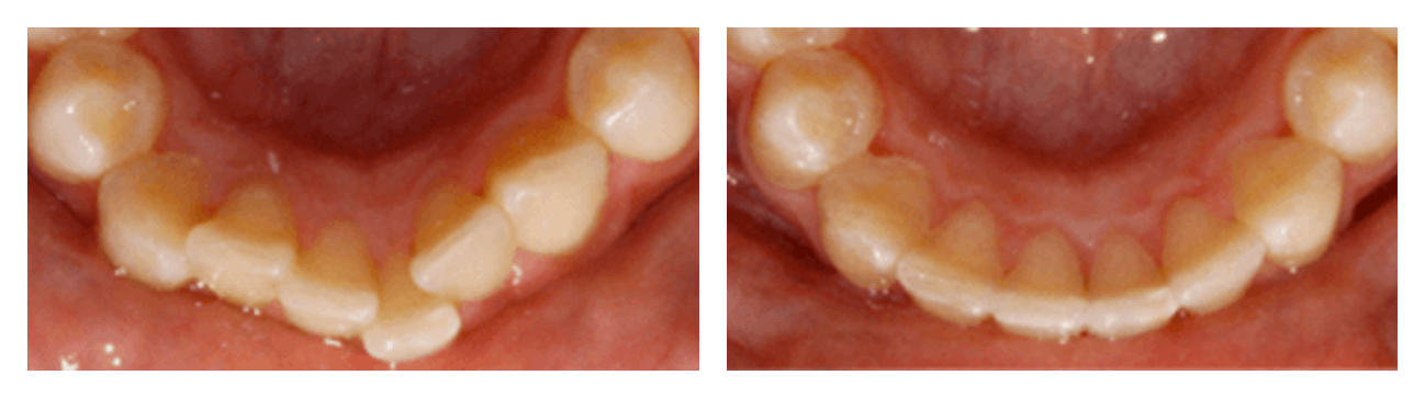 Invisalign Braces before and after