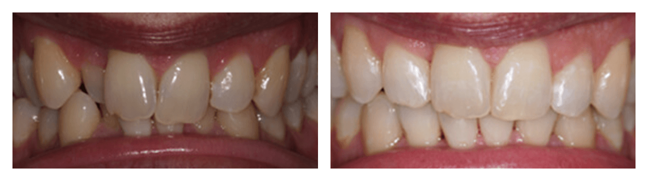 Cfast braces before & after
