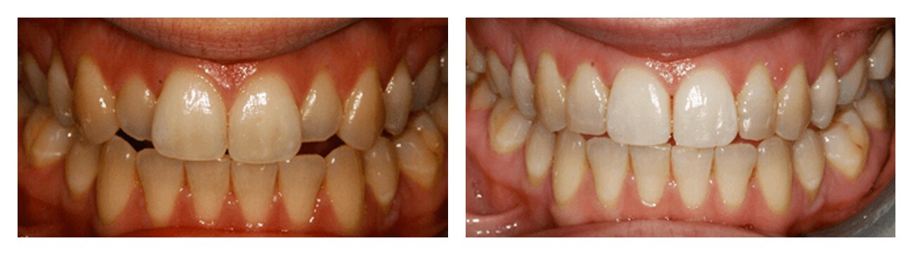 Inman Aligner And Cosmetic Bonding Before & After