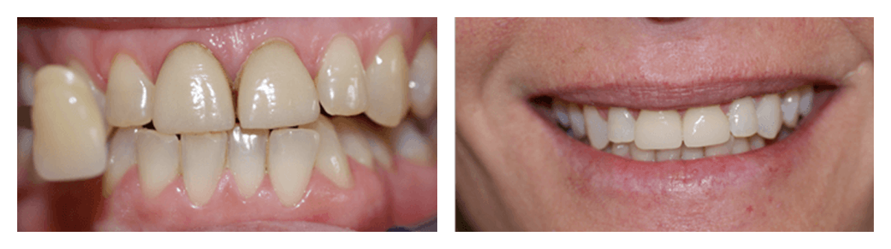 Cerec Crowns In A Single Visit Before & After