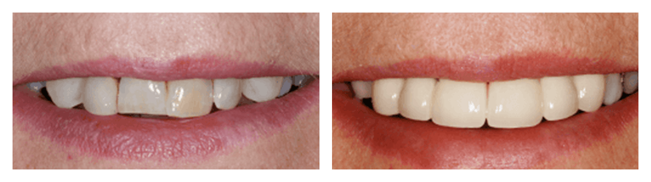 Smile Makeover Before & After